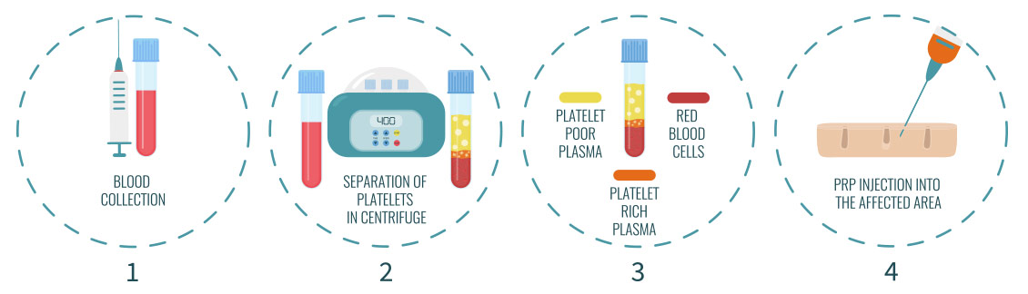 Platelet Rich Plasma Therapy Steps
