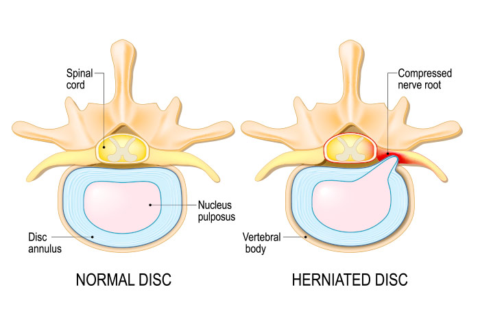 Regenerative Medicine for Herniated Discs