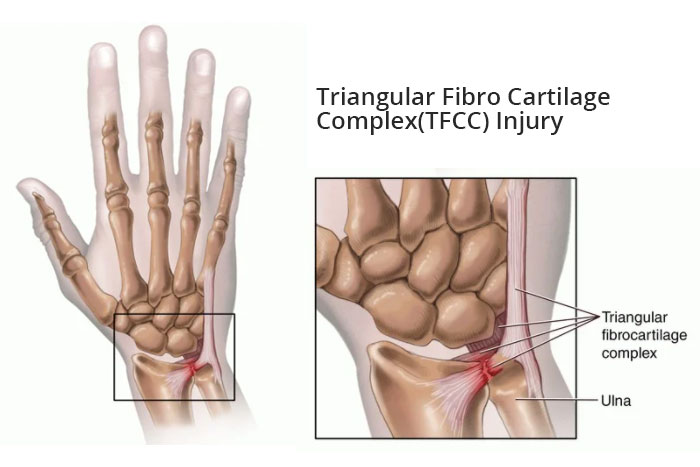 Forskellige adgang Regelmæssigt Triangular Fibrocartilage Complex (TFCC) Tear